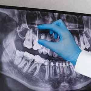 Dentist pointing to a patient’s X-ray