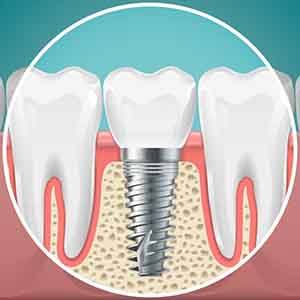 Digital image of a dental implant anchored to the jawbone