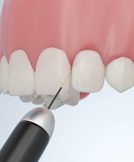 Illustration of a dental laser treating the gums