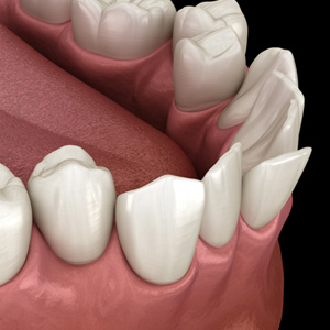 Illustration of crooked teeth