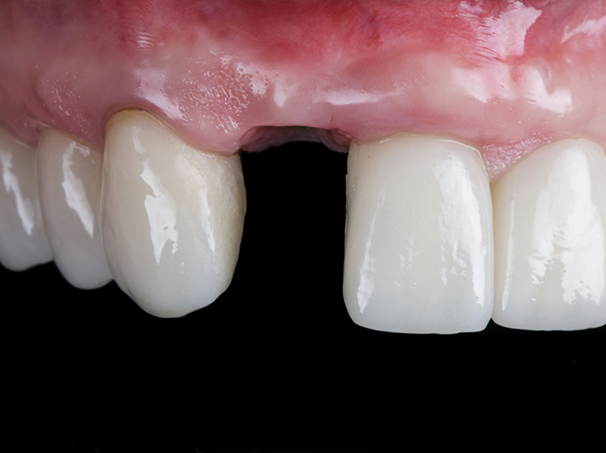 Close up of a mouth with one missing upper tooth