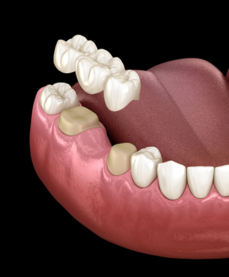 Illustration of a dental bridge being fitted over two teeth to replace the missing tooth between them