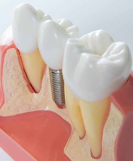 Model of a dental implant between two natural teeth