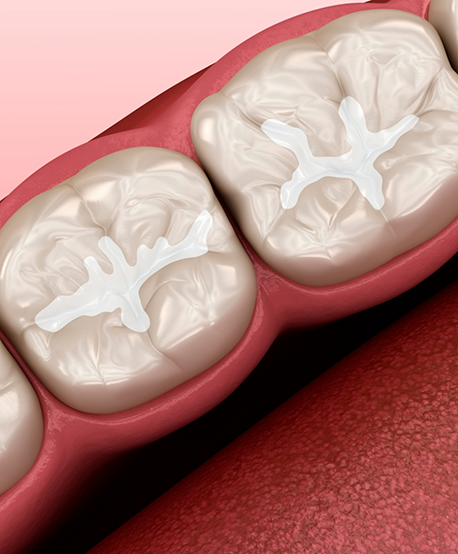 Illustration of a row of teeth with white fillings