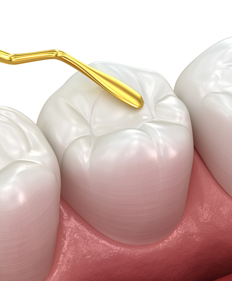 Illustration of a dental sealant being applied to a tooth