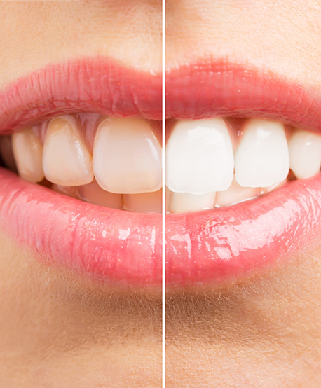 Close up of a smile before and after teeth whitening