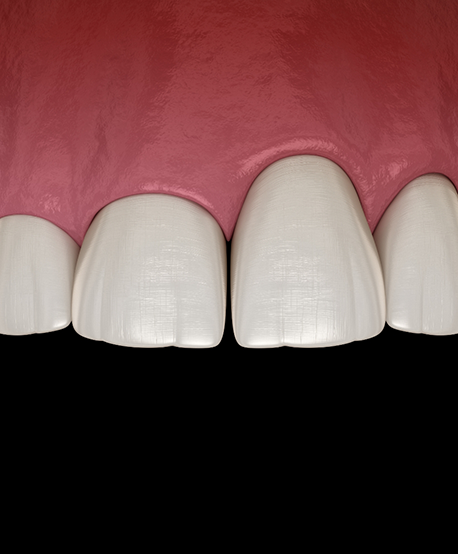 Illustration of a mouth with an uneven gumline above the upper teeth