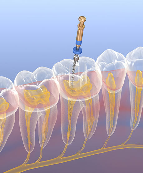 Illustration of a dental instrument performing a root canal on the center of a tooth