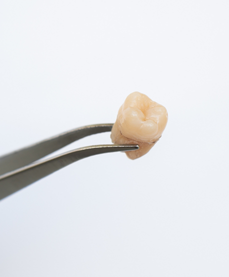 Tweezers holding an extracted tooth