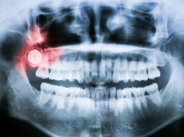 X ray of a person's teeth with an impacted wisdom tooth highlighted red