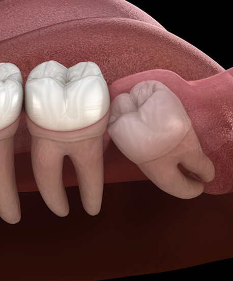 Illustration of an impacted wisdom tooth pressing against the tooth next to it