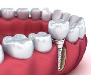 3d model of dental implants